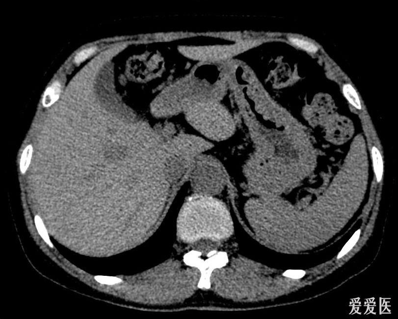 肝脏ct平扫 增强,讨论