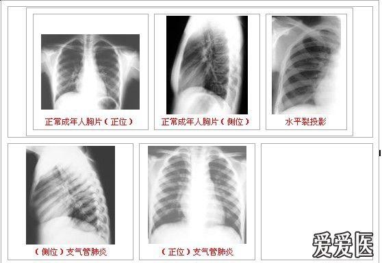 精心收集的60张胸部疾病的经典胸片(下附诊断说明)doc