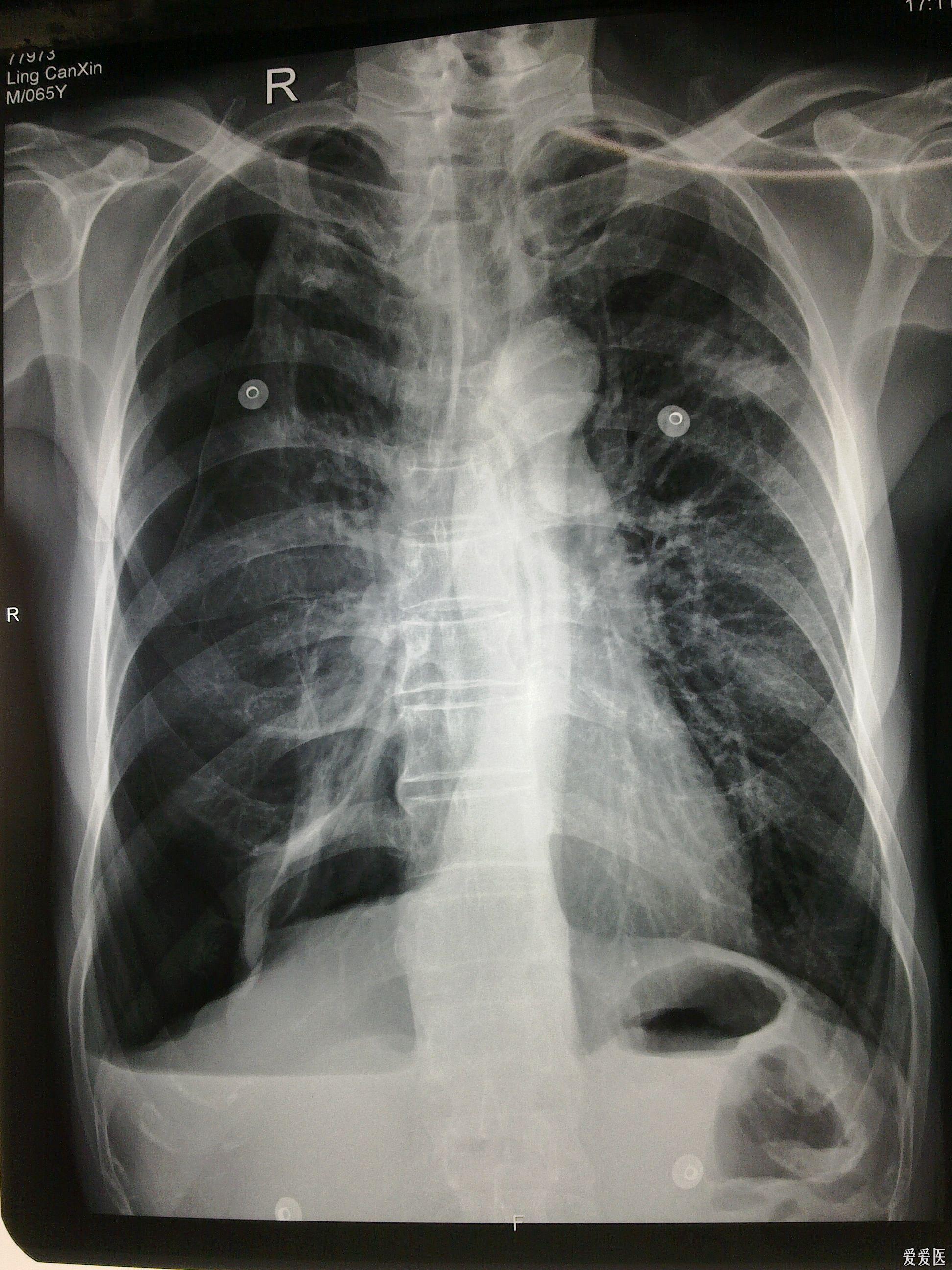 典型的结核病人液气胸胸片