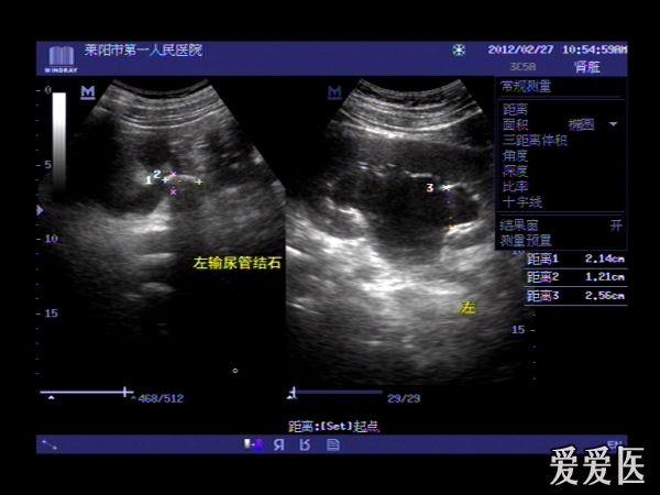 少见输尿管双侧结石并双侧肾积水一例 - 超声医学讨论