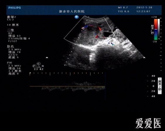 典型病例-转移性肝ca,腹水,库肯勃氏瘤.