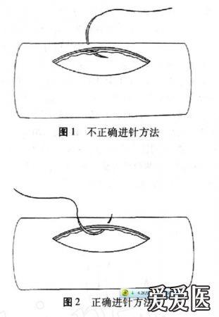 血管缝合及吻合基本技术与缝线材料指南与共识