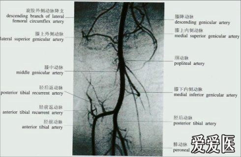 下肢动脉硬化闭塞症的诊治