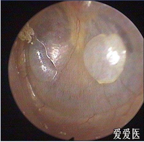鼓膜肿物 耳鼻咽喉-头颈外科专业版 爱爱医医学论坛-爱爱医医学网