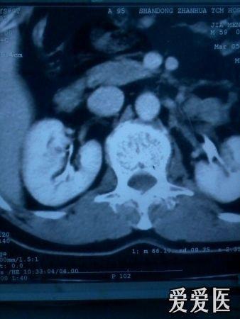 珍贵资料,这是先天肥大的肾柱?还是肿瘤?敬请讨论留言,待续