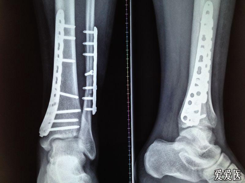 左胫腓骨下端骨折内固定3个月x光片,是否可以完全负重