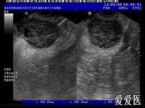 卵巢黄体血肿? - 超声医学讨论版 - 爱爱医医学论坛