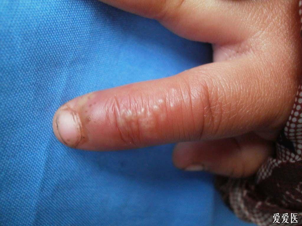 典型病例:手指单纯疱疹.