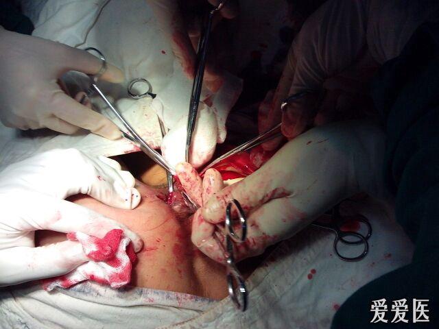 多发性肛瘘环痔术前术后欣赏