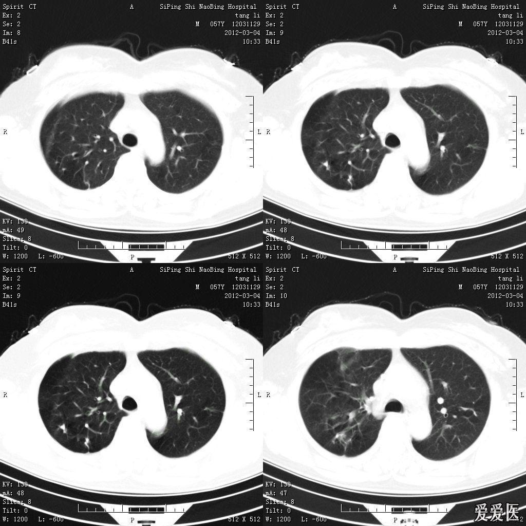 女性患者,57岁,20-30年曾诊断过肺结核,一年前透视结论为陈旧性肺结核