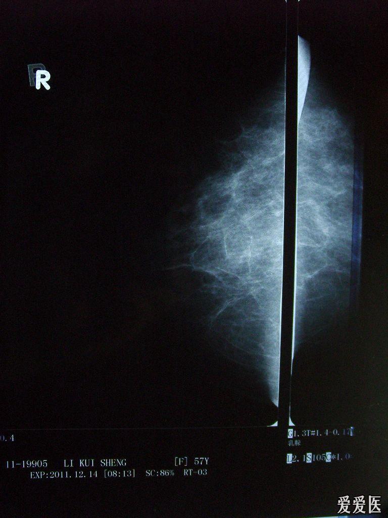 左侧乳腺外上象限探及一大小约7.8mm*6.