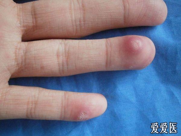 主诉:双手,足侧缘丘疹,结节,脓肿一个月余.
