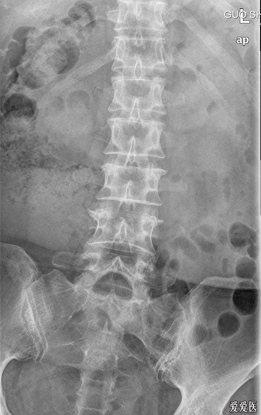 腰5椎体及骶1椎体病变(随访病理结果在13楼)