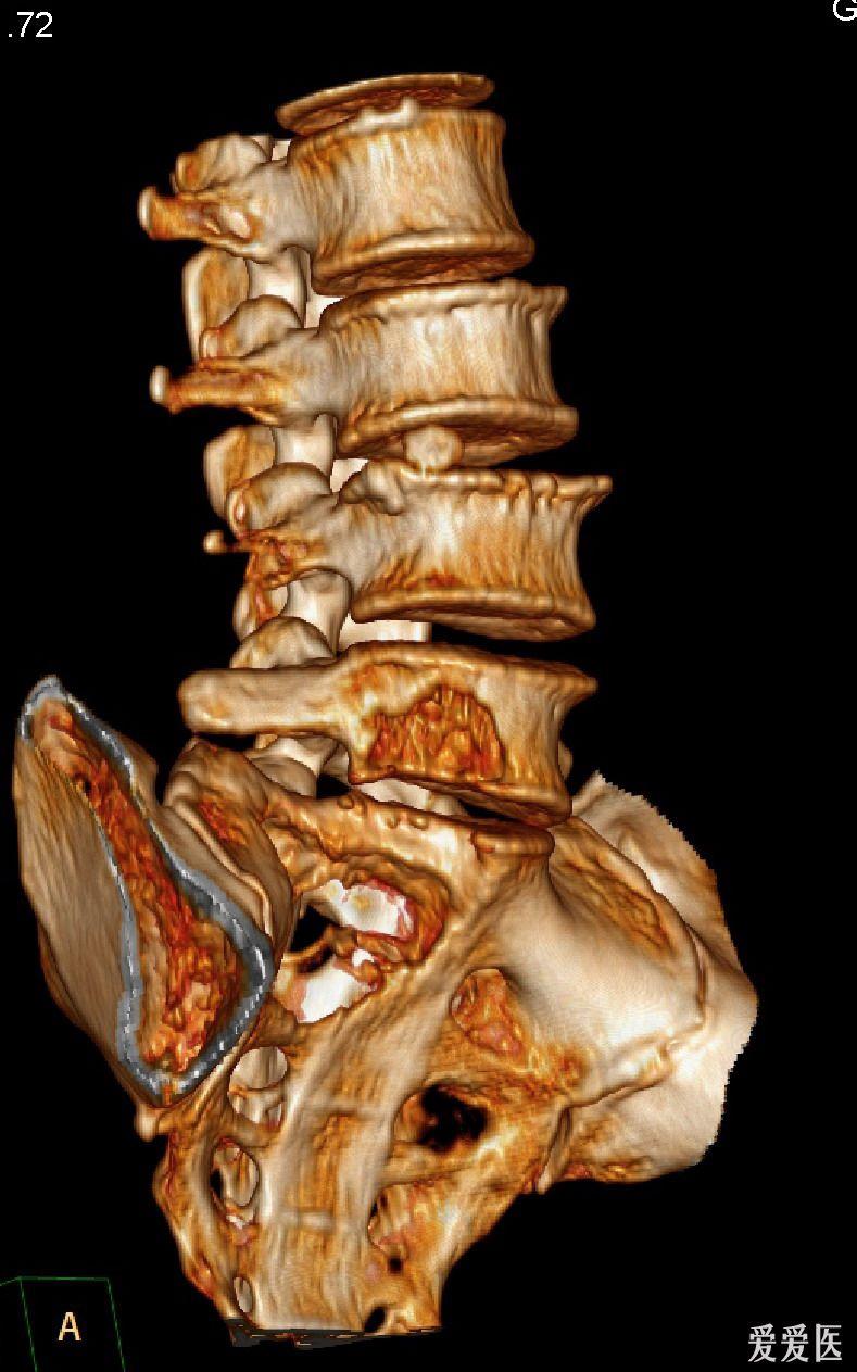 腰5椎体及骶1椎体病变(随访病理结果在13楼)
