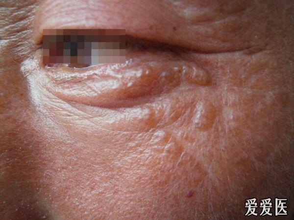 猜☆图☆病☆例☆(17)答案:胶样粟丘疹21人回答准确