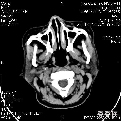 鼻前庭囊肿一例分享!