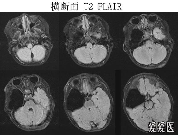 [看图说话]可能是什么病?右颞侧蛛网膜囊肿