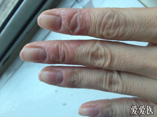 发红 边迹清楚 脱皮的边缘能看到许多小疙瘩 双手对称 不痒,指肚有些