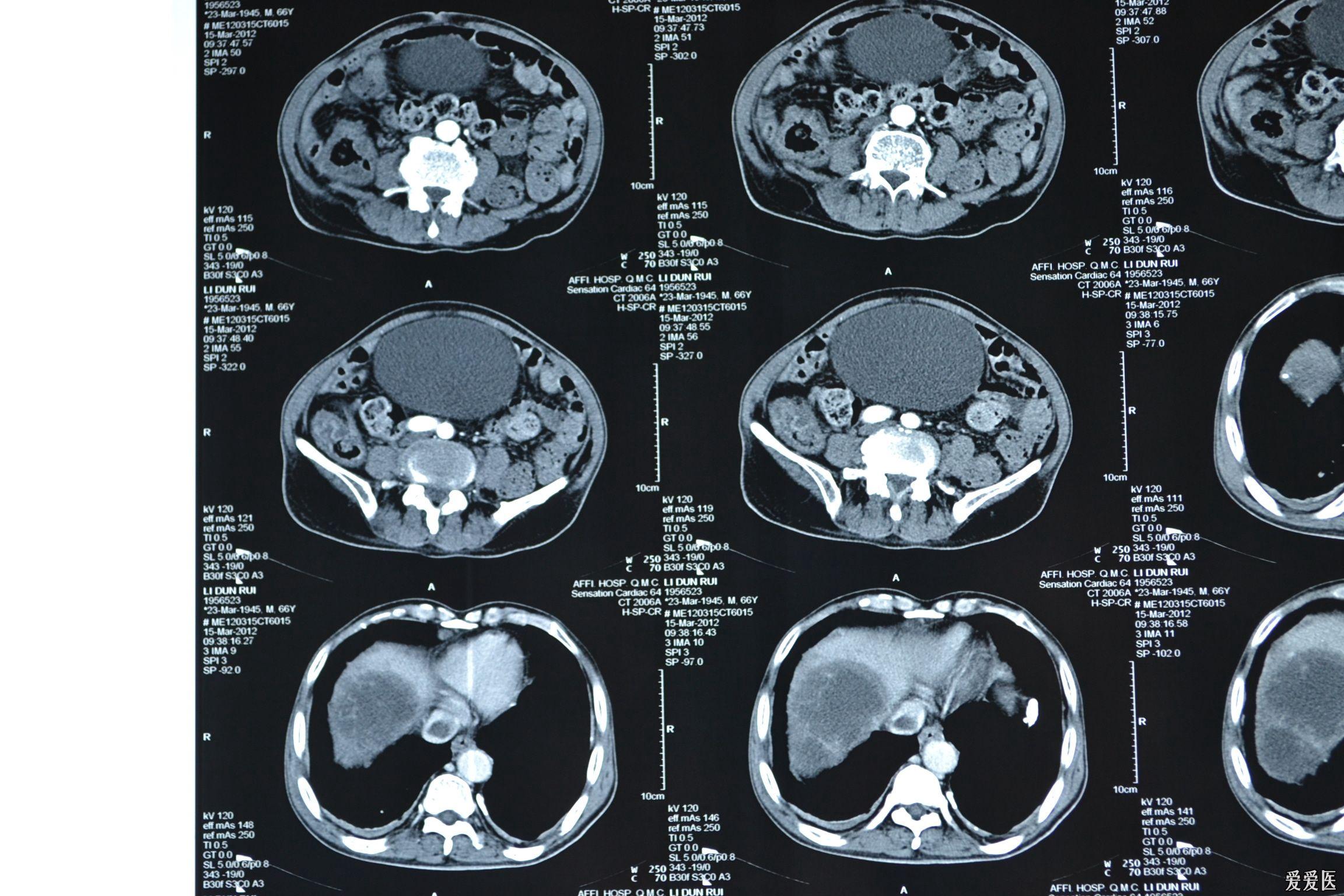 欣赏肝占位ct资料一,请求解决办法