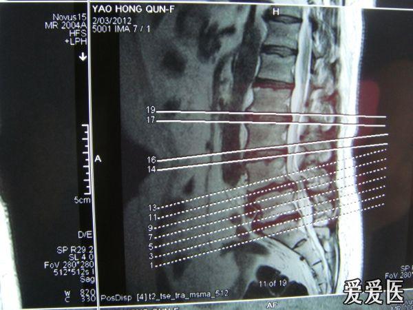 腰椎间盘突出并椎管狭窄