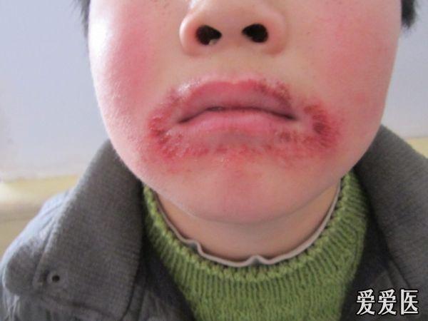 今天碰到的一个舌舔唇炎