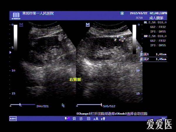 肾错构瘤 - 超声医学讨论版 - 爱爱医医学论坛 - 爱爱