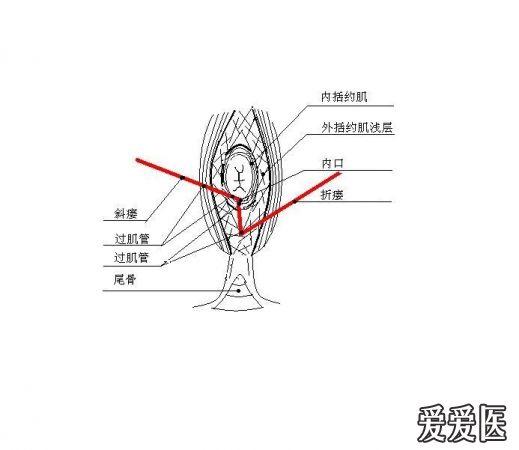 口后再后撤1cm,改变方向刺破瘘道壁穿透组织及皮肤至肛门后方肛周探出