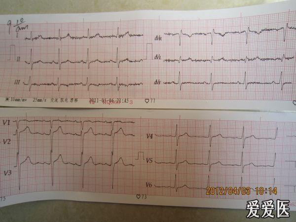 一例阵发性房颤的心电图演变