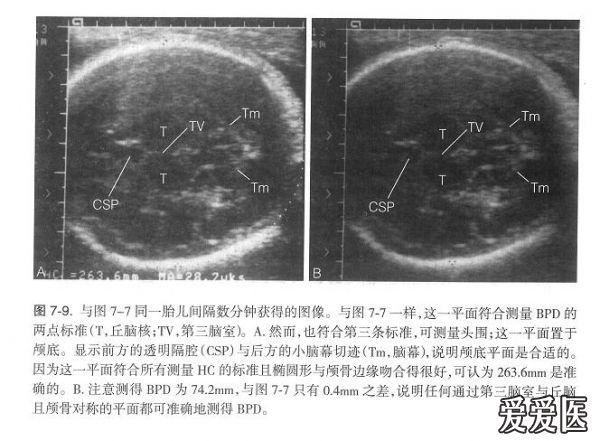 5楼回复cyst   第一二幅可测双顶径,但不是头围的标准切面,小脑幕以下