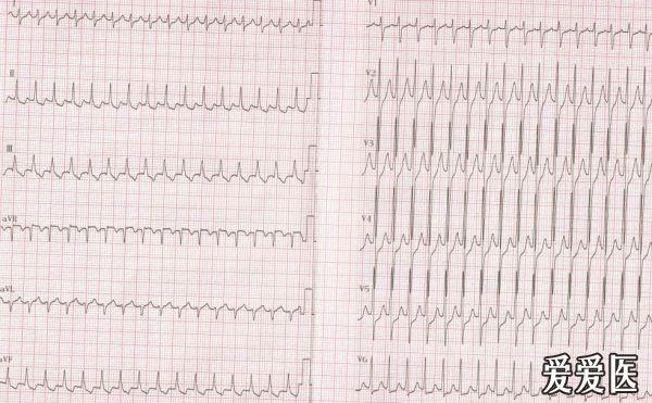 同一个患者会有室速,室上速同时发作吗?