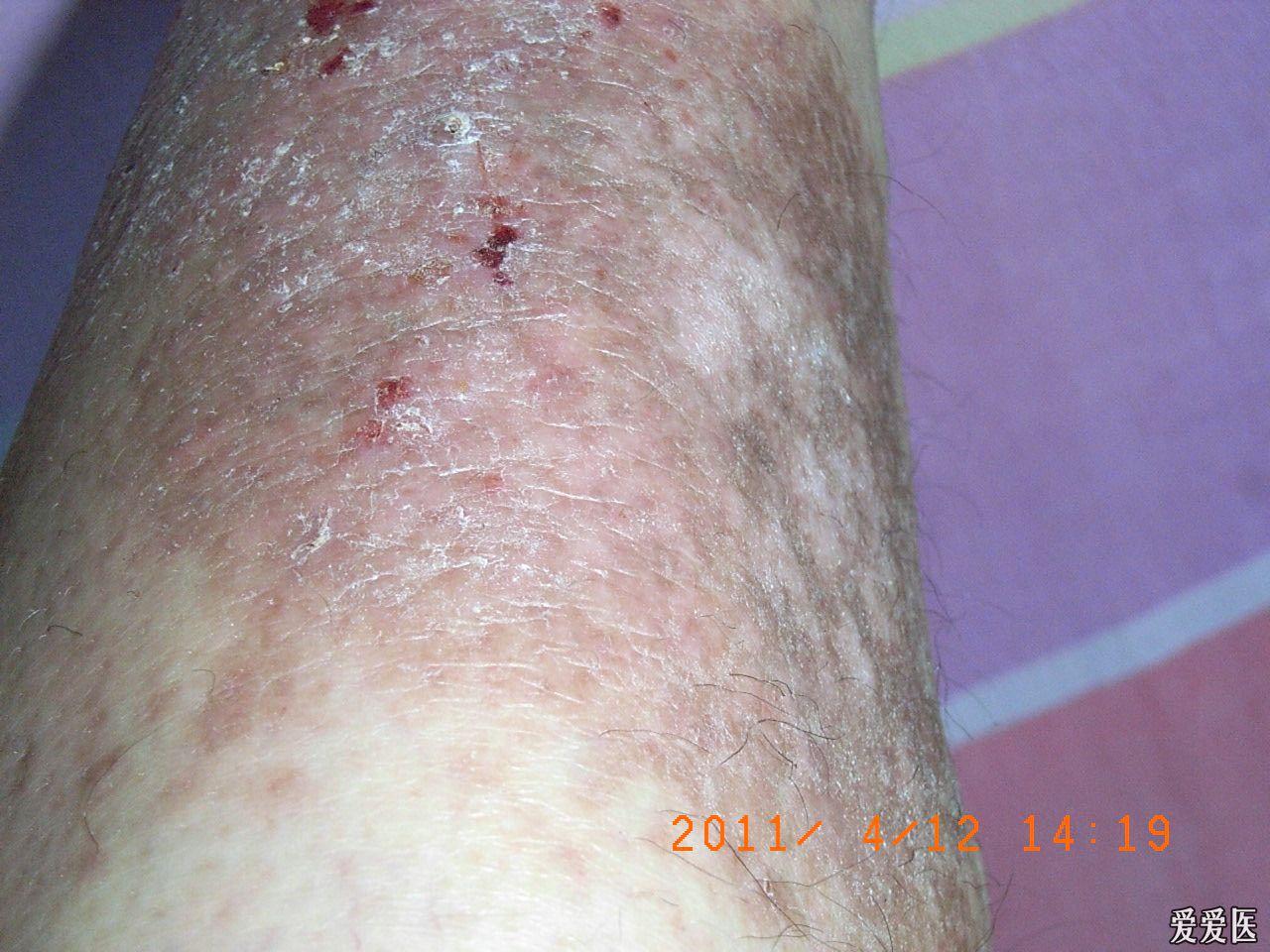 某男,47岁.6年前7月左小腿前部出现一簇红疹瘙痒,逐渐成为癣块