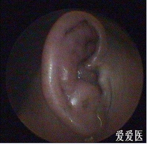 难缠的耳廓化脓性软骨膜炎
