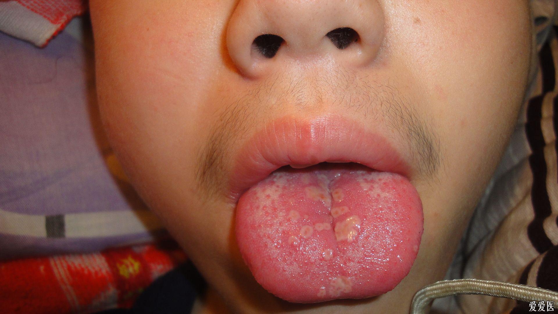 罕见的口腔疱疹,有图片.求治疗方法
