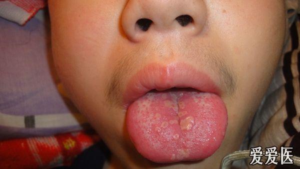 罕见的口腔疱疹,有图片.求治疗方法