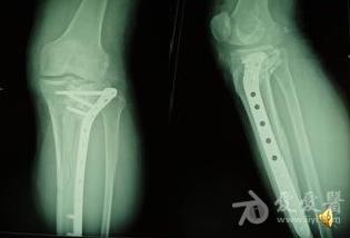 一例胫骨平台粉碎性骨折手术失败后翻修全过程