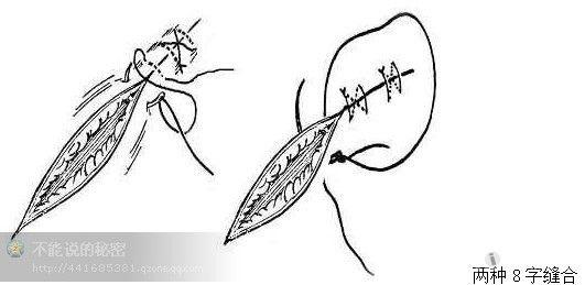 外科缝合的基本方法