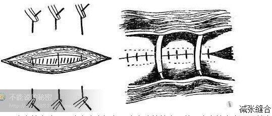 外科缝合的基本方法