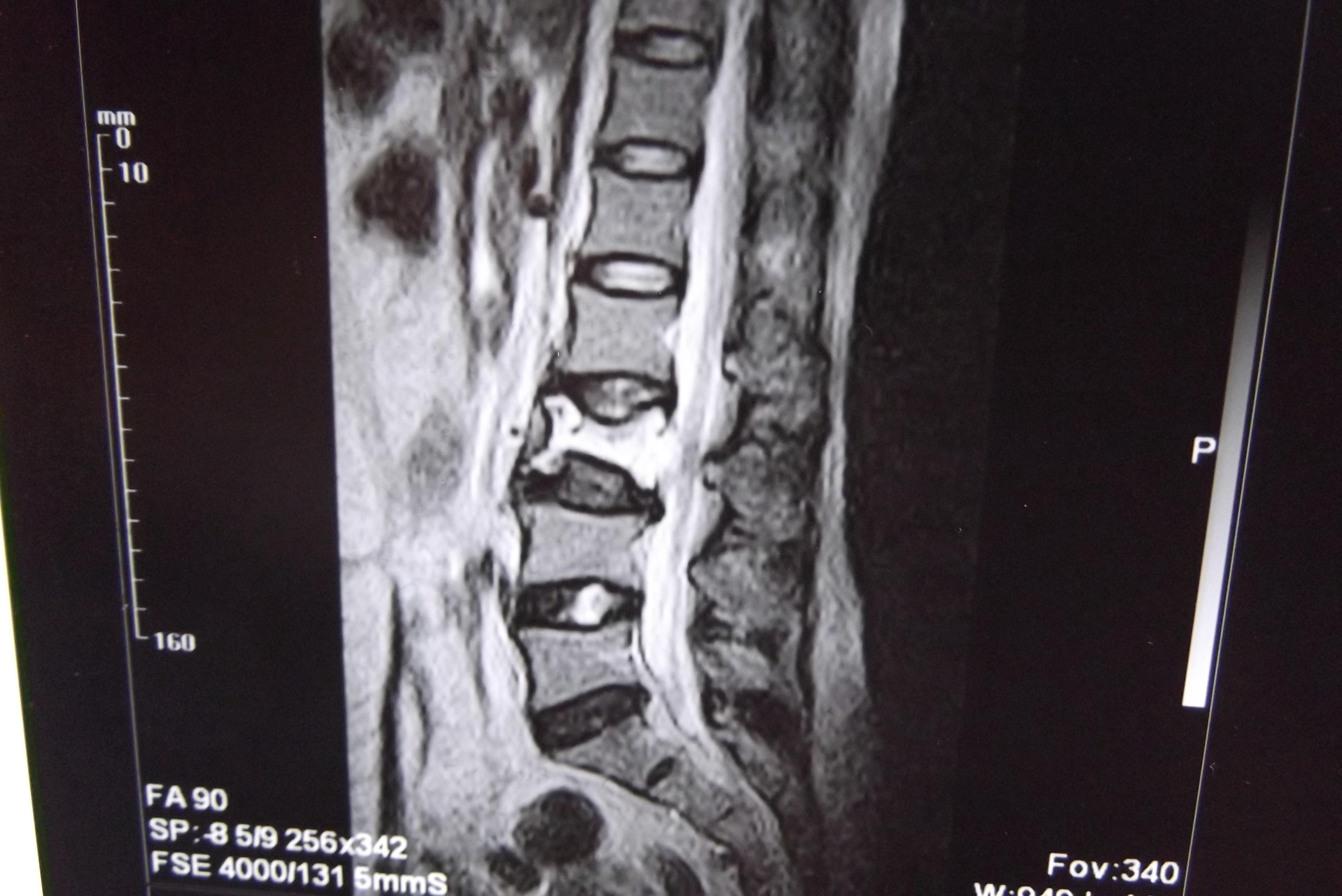 腰3椎体血管瘤怎么办?