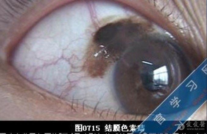 (三)恶性黑色素瘤(malignant melanoma )   结膜恶性黑色素瘤是潜在的