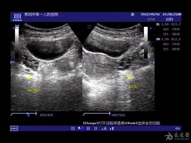 多囊卵巢综合征(pcos)和多卵泡卵巢(mfo 超声医学讨论版 爱爱医