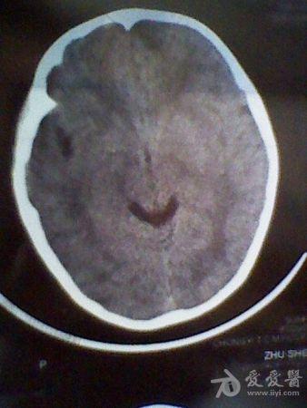 楼主小心驾船2012-05-01 16:49:34患儿,男,6岁,因"摔伤致头痛,头部
