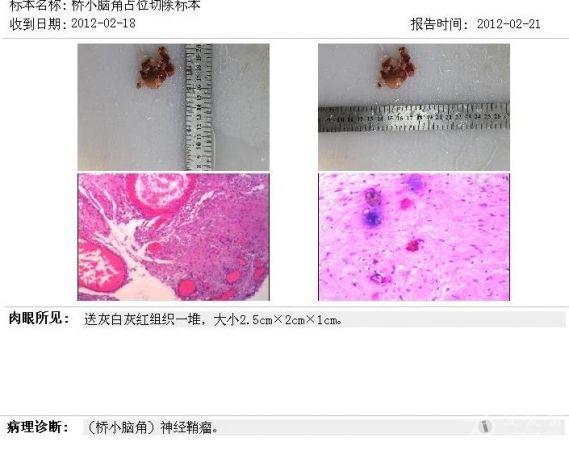weber试验:ac>bc; rinne试验:偏右.发音正常,咽反射正常.