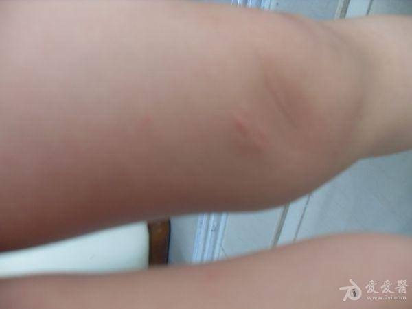 小儿皮疹(求助)
