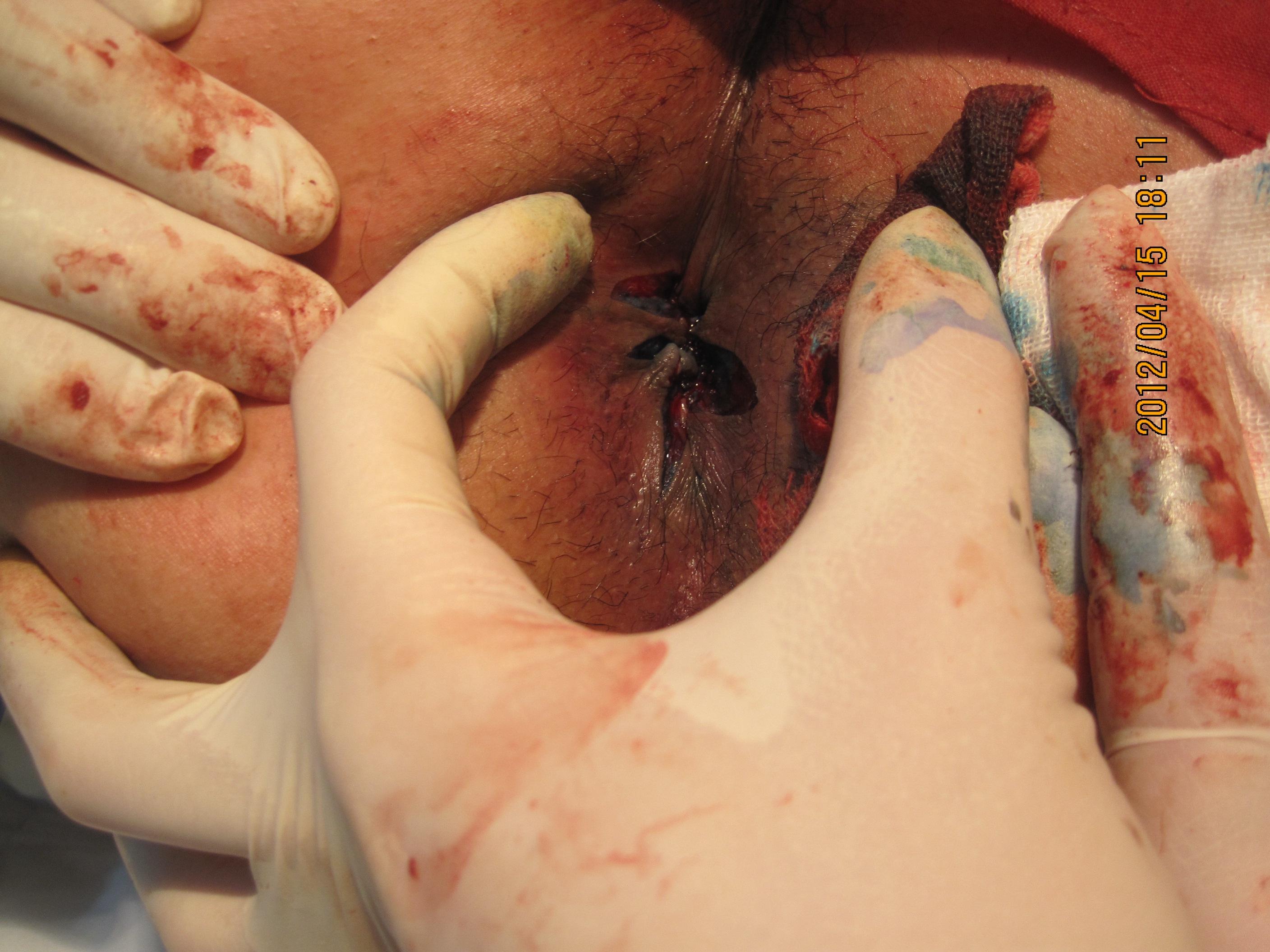 第二十三例三期超大环状结缔组织性混合痔术前术中术后图