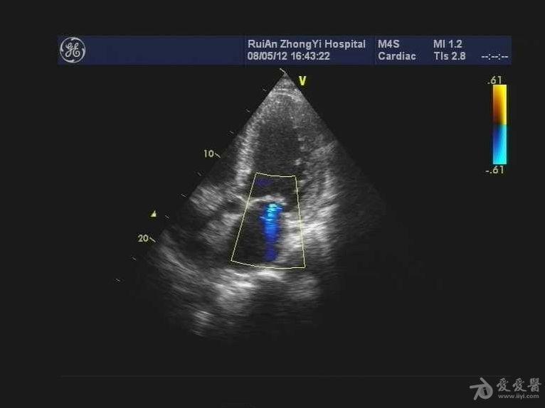 求助心尖部血栓吗?