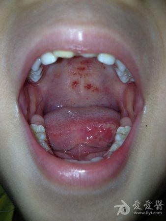 昨日患儿诉舌体疼痛,查体见:口腔上颚,左侧舌边尖及下唇均可见散在
