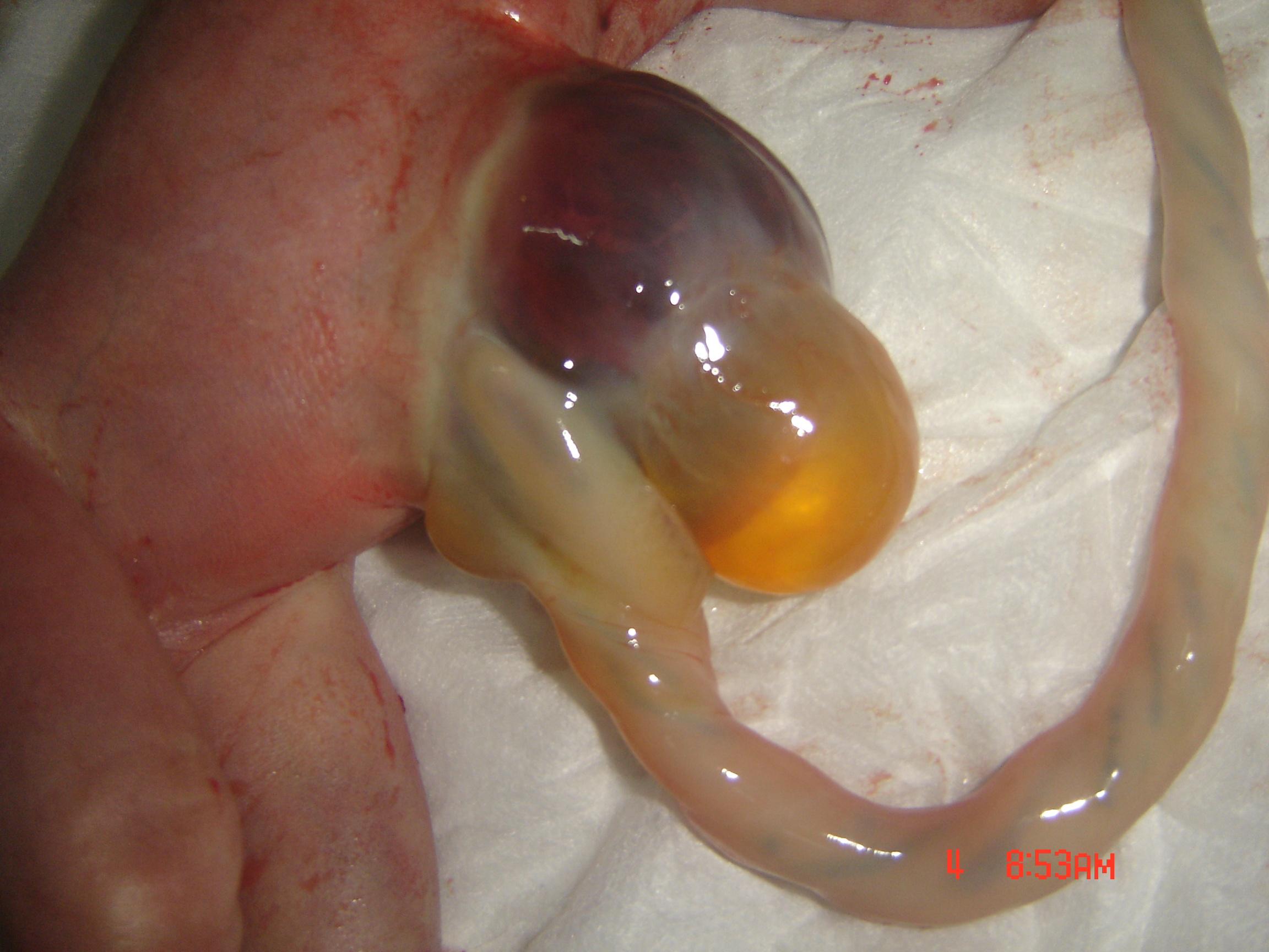 胎儿脐膨出一例(附引产后图片)