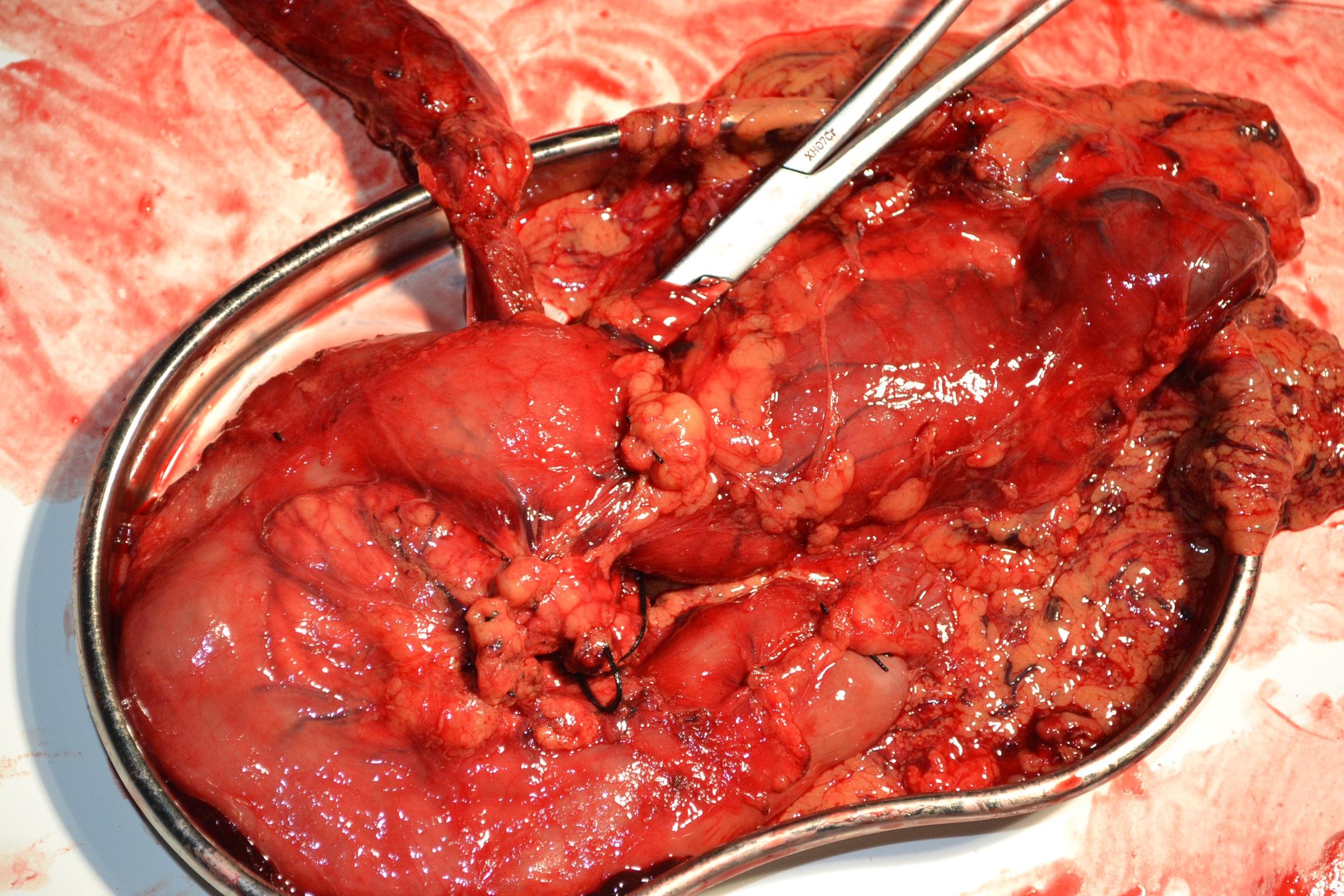 定义 壶腹癌是位於十二指肠第二部份内侧肠壁,因解剖位置之相关性