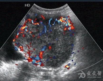 已确诊的晚期卵巢癌 - 超声医学讨论版 - 爱爱医医学