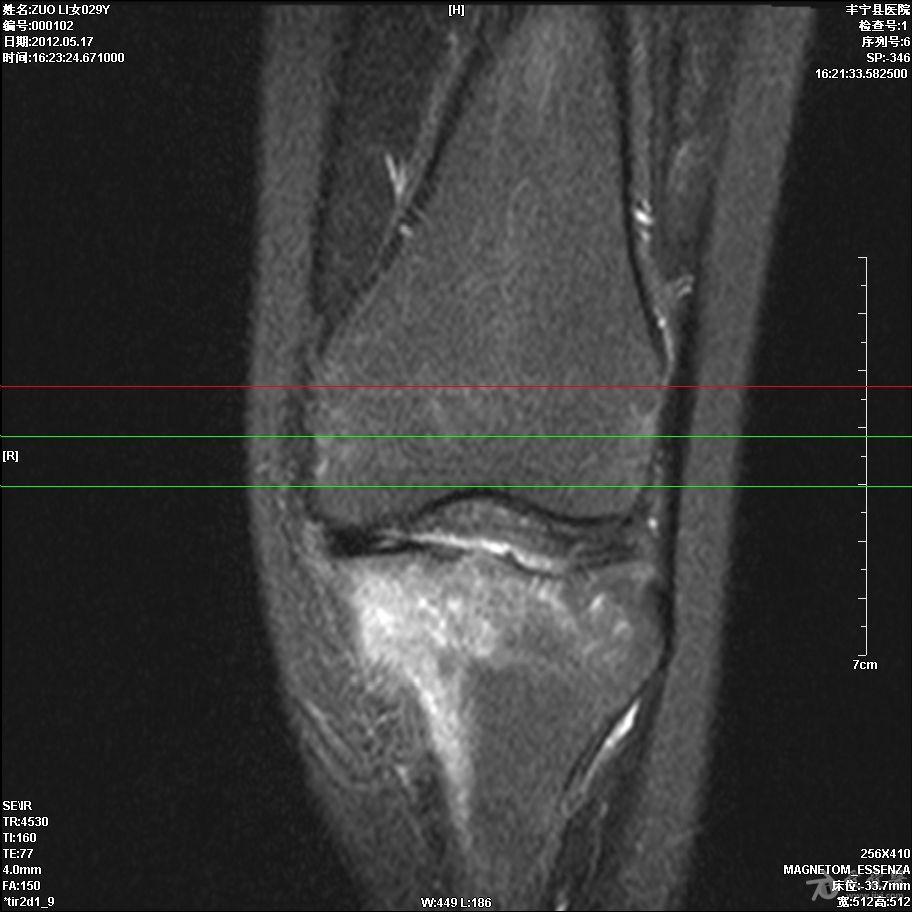 膝关节mri,骨挫伤